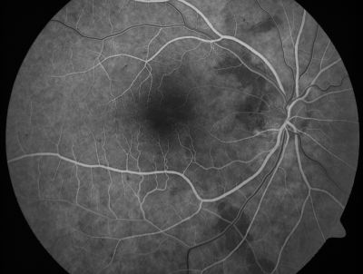 Retinal Vasculopathy associated with Facioscapulohumeral Muscular Dystrophy very early fa
59-year-old woman had a blood pressure spike to 170/90 and was on medications for that. She does have facioscapulohumeral muscular dystrophy, which runs in her family. She has a cousin with the same disorder.
VISUAL ACUITY: Her vision is 20/25 OU. IOP: OD 21, OS 18.
There is no posterior vitreous separation, telangiectatic vessels near the macula. There are patchy retinal hemorrhages. There is no edema or proliferation.

Võtmesõnad: diabetic like; systemic disease; vasculopathy; hemorrhage; bdr