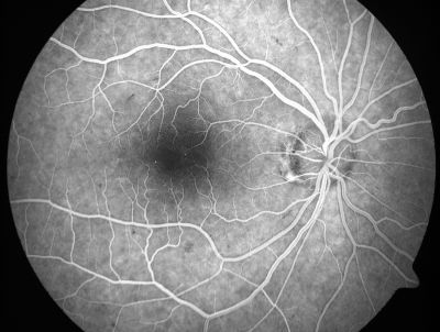 Retinal Vasculopathy associated with Facioscapulohumeral Muscular Dystrophy early fa
59-year-old woman had a blood pressure spike to 170/90 and was on medications for that. She does have facioscapulohumeral muscular dystrophy, which runs in her family. She has a cousin with the same disorder.
VISUAL ACUITY: Her vision is 20/25 OU. IOP: OD 21, OS 18.
There is no posterior vitreous separation, telangiectatic vessels near the macula. There are patchy retinal hemorrhages. There is no edema or proliferation.

Keywords: diabetic like; systemic disease; vasculopathy; hemorrhage; bdr