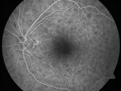 Retinal Vasculopathy associated with Facioscapulohumeral Muscular Dystrophy early fa
59-year-old woman had a blood pressure spike to 170/90 and was on medications for that. She does have facioscapulohumeral muscular dystrophy, which runs in her family. She has a cousin with the same disorder.
VISUAL ACUITY: Her vision is 20/25 OU. IOP: OD 21, OS 18.
There is no posterior vitreous separation, telangiectatic vessels near the macula. There are patchy retinal hemorrhages. There is no edema or proliferation.

Keywords: diabetic like; systemic disease; vasculopathy; hemorrhage; bdr