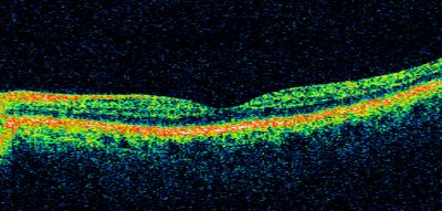 Retinal Vasculopathy associated with Facioscapulohumeral Muscular Dystrophy line os
59-year-old woman had a blood pressure spike to 170/90 and was on medications for that. She does have facioscapulohumeral muscular dystrophy, which runs in her family. She has a cousin with the same disorder.
VISUAL ACUITY: Her vision is 20/25 OU. IOP: OD 21, OS 18.
There is no posterior vitreous separation, telangiectatic vessels near the macula. There are patchy retinal hemorrhages. There is no edema or proliferation.

Keywords: diabetic like; systemic disease; vasculopathy; hemorrhage; bdr