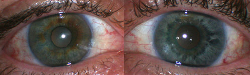 Fuchs Heterochromic Iridocyclitis - Left eye has inflammation
The right eye is darker than the left eye which has chronic iritis
