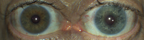 Fuch's Heterochromic Iridocyclitis - Iris Photos
71 year old man with inflammation in the left eye for over 50 years.  The left eye got a tube shunt 15 years ago.  Vision is 20/32 OD, 20/40 OS
