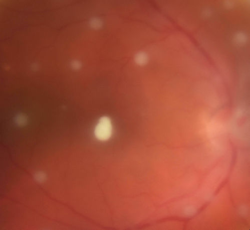 Exogenous Fungal Endophthalmitis
69 year old female with endophthalmitis 2 months after ECCE.  Treated with vitrectomy and 3 injections of amphotericin B.  Vision improved from 5/200 - 20/50
