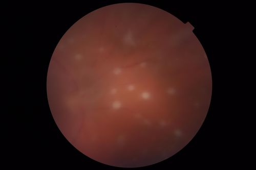 Exogenous Fungal Endophthalmitis
69 year old female with endophthalmitis 2 months after ECCE.  Treated with vitrectomy and 3 injections of amphotericin B.  Vision improved from 5/200 - 20/50

