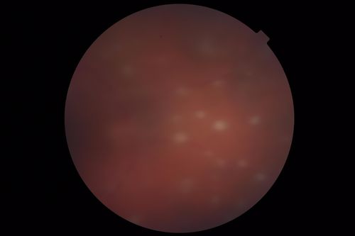 Exogenous Fungal Endophthalmitis
69 year old female with endophthalmitis 2 months after ECCE.  Treated with vitrectomy and 3 injections of amphotericin B.  Vision improved from 5/200 - 20/50
