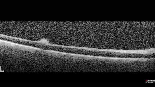 Exogenous Fungal Endophthalmitis
69 year old female with endophthalmitis 2 months after ECCE.  Treated with vitrectomy and 3 injections of amphotericin B.  Vision improved from 5/200 - 20/50
