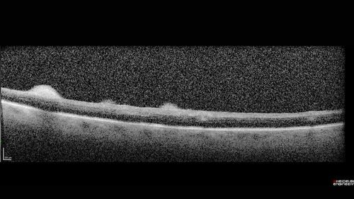 Exogenous Fungal Endophthalmitis
69 year old female with endophthalmitis 2 months after ECCE.  Treated with vitrectomy and 3 injections of amphotericin B.  Vision improved from 5/200 - 20/50

