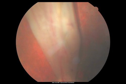 Closed Funnel Retinal Detachment Under Silicone Oil - NLP Vision
15-year-old slowly developing cataract in the left eye over about the last three years.  His cataract was already dense when it was removed August 3rd of 2009.  The preoperative ultrasound suggested the retina might be abnormal and then once the retina was detached, it was clear that he had a retinal detachment.  Because of the amount of scarring the retina was impossible to unfold and it was reattached in a closed funnel formation.  

VISUAL ACUITY:  OD 20/30, OS: NLP.  

