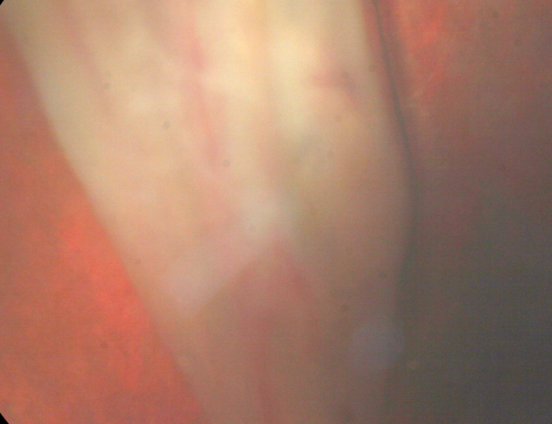 Closed Funnel Retinal Detachment Under Silicone Oil - NLP Vision
15-year-old slowly developing cataract in the left eye over about the last three years.  His cataract was already dense when it was removed August 3rd of 2009.  The preoperative ultrasound suggested the retina might be abnormal and then once the retina was detached, it was clear that he had a retinal detachment.  Because of the amount of scarring the retina was impossible to unfold and it was reattached in a closed funnel formation.  

VISUAL ACUITY:  OD 20/30, OS: NLP.  
