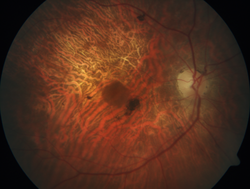 Concentric Geographic Atrophy
76 year old man Gradual vision loss
20/32 OD; 20/40 OS
No medicines, Non-smoker
Working and Driving
