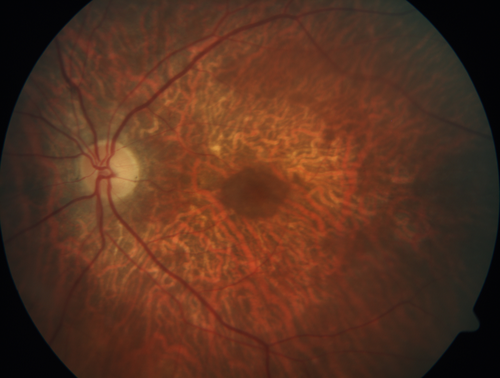 Concentric Geographic Atrophy
76 year old man Gradual vision loss
20/32 OD; 20/40 OS
No medicines, Non-smoker
Working and Driving
