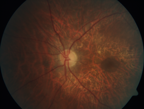 Concentric Geographic Atrophy
76 year old man Gradual vision loss
20/32 OD; 20/40 OS
No medicines, Non-smoker
Working and Driving
