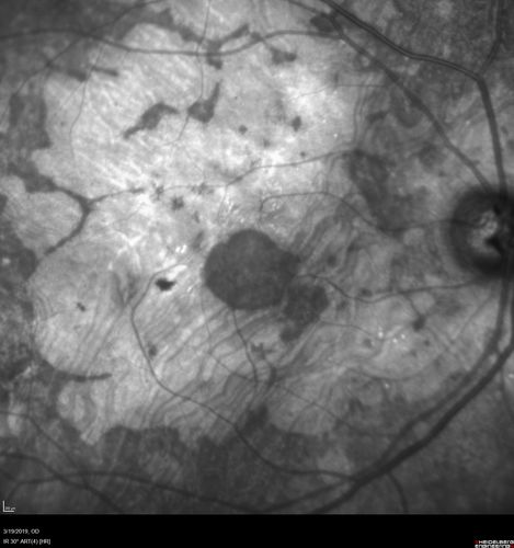 Concentric Geographic Atrophy - 76 year old man
Gradual vision loss, worse at night.  VA 20/40 OU.
