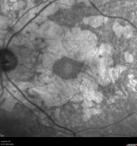 Concentric Geographic Atrophy
76 year old man Gradual vision loss
20/32 OD; 20/40 OS
No medicines, Non-smoker
Working and Driving
