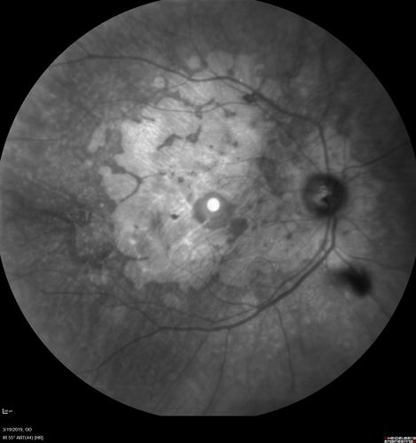 Concentric Geographic Atrophy
76 year old man Gradual vision loss
20/32 OD; 20/40 OS
No medicines, Non-smoker
Working and Driving
