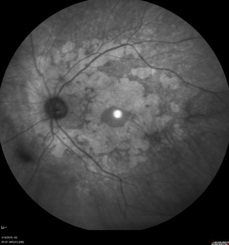 Concentric Geographic Atrophy - 76 year old man
Gradual vision loss, worse at night.  VA 20/40 OU.
