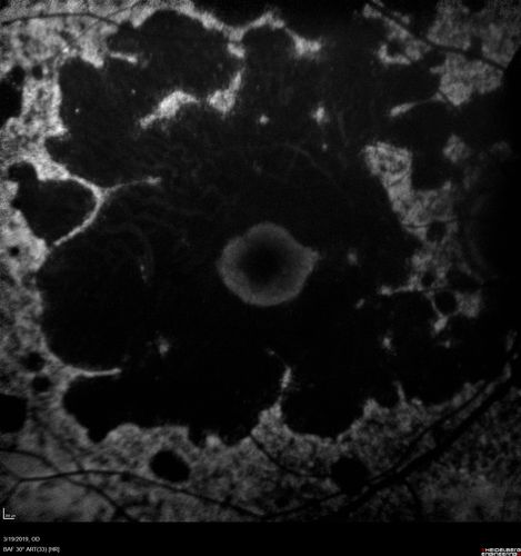 Concentric Geographic Atrophy
76 year old man Gradual vision loss
20/32 OD; 20/40 OS
No medicines, Non-smoker
Working and Driving
