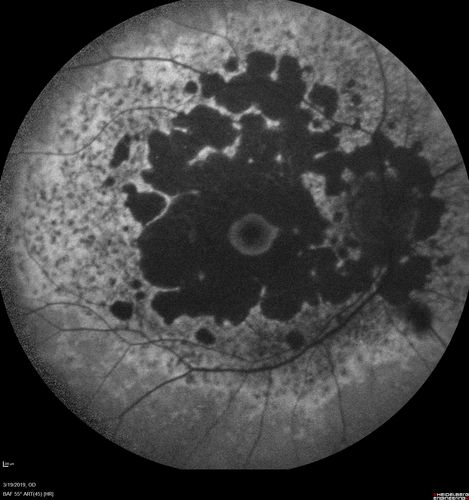 Concentric Geographic Atrophy - 76 year old man
Gradual vision loss, worse at night.  VA 20/40 OU.
