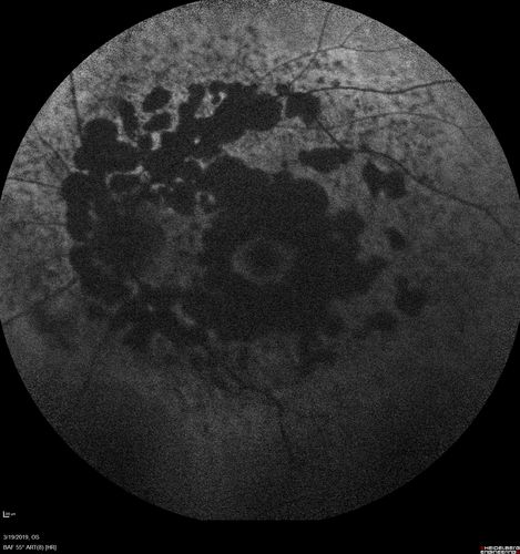 Concentric Geographic Atrophy - 76 year old man
Gradual vision loss, worse at night.  VA 20/40 OU.
