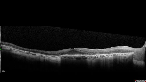 Concentric Geographic Atrophy
76 year old man Gradual vision loss
20/32 OD; 20/40 OS
No medicines, Non-smoker
Working and Driving
