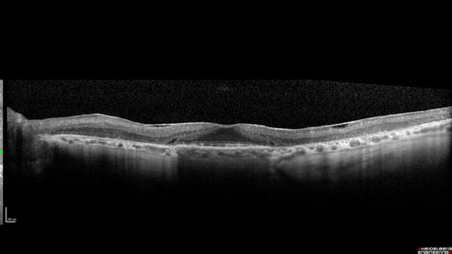 Concentric Geographic Atrophy
76 year old man Gradual vision loss
20/32 OD; 20/40 OS
No medicines, Non-smoker
Working and Driving
