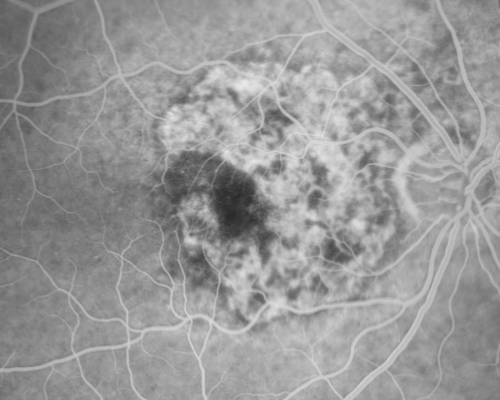 Geographic Atrophy and Age-Related Macular Degeneration - Choriocapillaris is Largely Still Intact
85-year-old woman has age-related macular degeneration in both eyes with geographic atrophy.  She has noticed her vision getting slightly worse in the past 6 months. VISUAL ACUITY:  OD 20/70, OS 20/400
