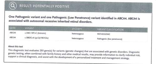 25 year old with Stargard and 2 ABCA4 mutations.
She has worn glasses since she was a kid.  Since she became an adult her vision started to deteriorate more rapidly.  This seems to have been happening since she entered the accounting department for the last two years.  Her vision is worse in the light especially when she is driving.  She can see green lights in the night but not in the day.  She sees better on a dark background than on a light background.  Her mom is genetically visually impaired with Stargardts.  Her father has RP.  The mother was genetically tested in Boston about 23 years ago.  That was when the gene was first being isolated. (The mother has seven brothers and sisters and four have stargardts and they are legally blind.  Also one cousin has it.)
VA OD: Dcc20/160-1 PH20/80 Ncc20/200-2
VA OS: Dcc20/160-2 PH20/80-1 Ncc20/200-1
IOP: TP: OD:20 OS:21
