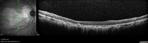 Severe Geographic Atrophy from Dry Age-Related Macular Degeneration
90 year old female with severe vision loss over the last few years.  
VA 3/200 OD
1/200 OS
