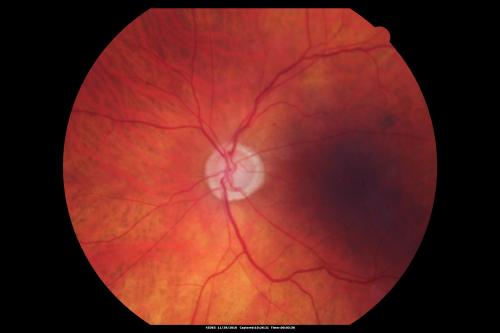 Glaucoma (also Diabetes and Previous Retinal Detachment both Eyes)
84-year-old man has had retinal detachment repairs in both eyes.  He also has advanced optic atrophy.  He also has had diabetes for thirty five years.  OD 20/30,  OS 20/40

