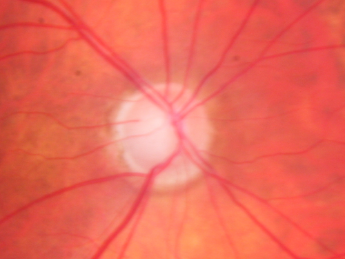 Glaucoma (also Diabetes and Previous Retinal Detachment both Eyes)
84-year-old man has had retinal detachment repairs in both eyes.  He also has advanced optic atrophy.  He also has had diabetes for thirty five years.  OD 20/30,  OS 20/40
