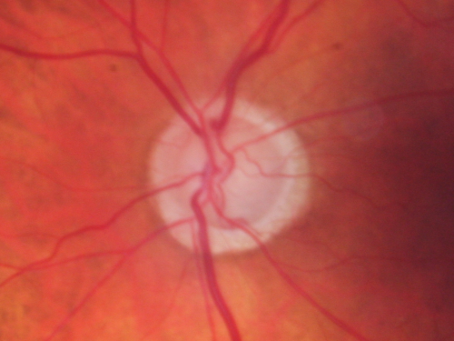 Glaucoma (also Diabetes and Previous Retinal Detachment both Eyes)
84-year-old man has had retinal detachment repairs in both eyes.  He also has advanced optic atrophy.  He also has had diabetes for thirty five years.  OD 20/30,  OS 20/40
