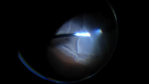 Giant Retinal Tear Retinal Detachment
13 year old african american girl high myope.  These intra-operative photos show parts of the procedure for this giant tear detachment.  The video is on youtube.  You can see the center of the macula with no overlying retina.
