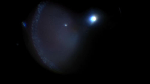 Giant Retinal Tear Retinal Detachment
13 year old african american girl high myope.  These intra-operative photos show parts of the procedure for this giant tear detachment.  The video is on youtube.  You can see the center of the macula with no overlying retina.
