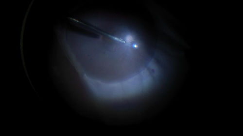 Giant Retinal Tear Retinal Detachment
13 year old african american girl high myope.  These intra-operative photos show parts of the procedure for this giant tear detachment.  The video is on youtube.  You can see the center of the macula with no overlying retina.
