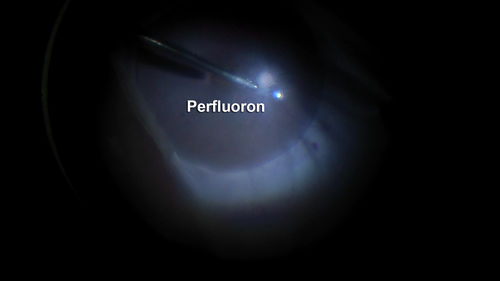 Giant Retinal Tear Retinal Detachment
13 year old african american girl high myope.  These intra-operative photos show parts of the procedure for this giant tear detachment.  The video is on youtube.  You can see the center of the macula with no overlying retina.
