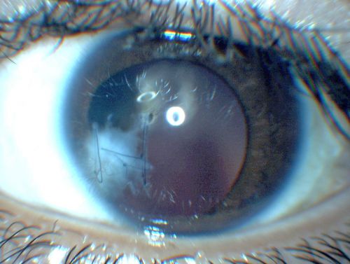 Shotgun wound to face with Perforating Pellet - Final Vision 20/400 
18-year-old had a gunshot wound to the left eye.  He had surgery on December 31st (1 week post injury) and February 4th and his vision has remarkably done well.

VISUAL ACUITY:  Vision OS is 3/200.  
Keywords: choroidal rupture;trauma