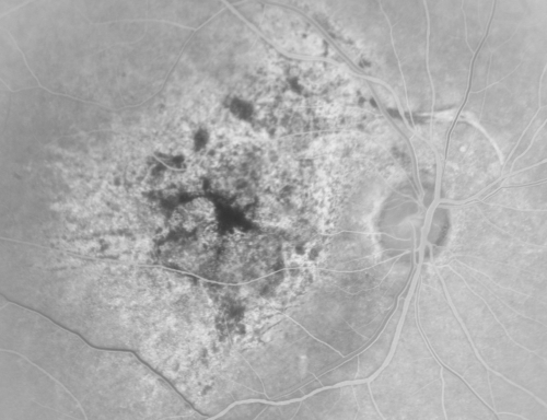 Pistol to head in attempted suicide 3 Months Ago - Retinal Atrophy - Shockwave Retinopathy VA Right Eye - Light Perception - Left Eye - 20/400
66-year-old woman had a gunshot wound to the head on August 12, 2010, with the entry wound just on the right side, just about below her temple, toward the lower part of the temple and the exit wound on the left side just above her cheek, a little behind the eye.  Since then she recovered and did not need any surgery.  When that all cleared she realized her vision was poor in both eyes.  She has seen a neuro-ophthalmologist who thought she had traumatic optic neuropathy.   OD light perception, OS 20/400. 
