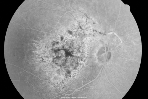 Pistol to head in attempted suicide 3 Months Ago - Retinal Atrophy - Shockwave Retinopathy VA Right Eye - Light Perception - Left Eye - 20/400
66-year-old woman had a gunshot wound to the head on August 12, 2010, with the entry wound just on the right side, just about below her temple, toward the lower part of the temple and the exit wound on the left side just above her cheek, a little behind the eye.  Since then she recovered and did not need any surgery.  When that all cleared she realized her vision was poor in both eyes.  She has seen a neuro-ophthalmologist who thought she had traumatic optic neuropathy.   OD light perception, OS 20/400. 
