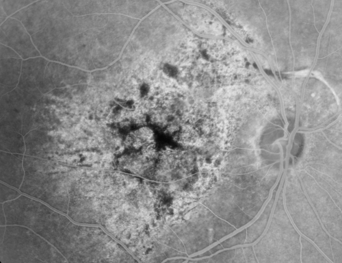 Pistol to head in attempted suicide 3 Months Ago - Retinal Atrophy - Shockwave Retinopathy VA Right Eye - Light Perception - Left Eye - 20/400
66-year-old woman had a gunshot wound to the head on August 12, 2010, with the entry wound just on the right side, just about below her temple, toward the lower part of the temple and the exit wound on the left side just above her cheek, a little behind the eye.  Since then she recovered and did not need any surgery.  When that all cleared she realized her vision was poor in both eyes.  She has seen a neuro-ophthalmologist who thought she had traumatic optic neuropathy.   OD light perception, OS 20/400. 
