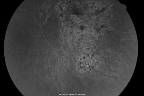 Pistol to head in attempted suicide 3 Months Ago - Retinal Atrophy - Shockwave Retinopathy VA Right Eye - Light Perception - Left Eye - 20/400
66-year-old woman had a gunshot wound to the head on August 12, 2010, with the entry wound just on the right side, just about below her temple, toward the lower part of the temple and the exit wound on the left side just above her cheek, a little behind the eye.  Since then she recovered and did not need any surgery.  When that all cleared she realized her vision was poor in both eyes.  She has seen a neuro-ophthalmologist who thought she had traumatic optic neuropathy.   OD light perception, OS 20/400. 

