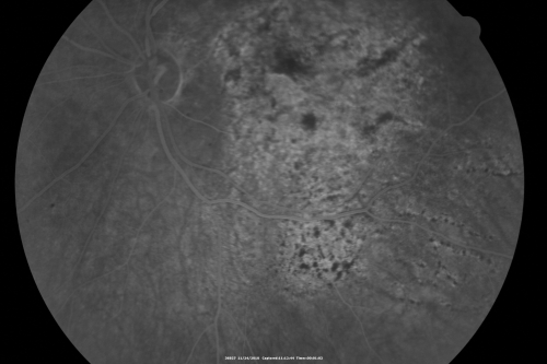 Pistol to head in attempted suicide 3 Months Ago - Retinal Atrophy - Shockwave Retinopathy VA Right Eye - Light Perception - Left Eye - 20/400
66-year-old woman had a gunshot wound to the head on August 12, 2010, with the entry wound just on the right side, just about below her temple, toward the lower part of the temple and the exit wound on the left side just above her cheek, a little behind the eye.  Since then she recovered and did not need any surgery.  When that all cleared she realized her vision was poor in both eyes.  She has seen a neuro-ophthalmologist who thought she had traumatic optic neuropathy.   OD light perception, OS 20/400. 
