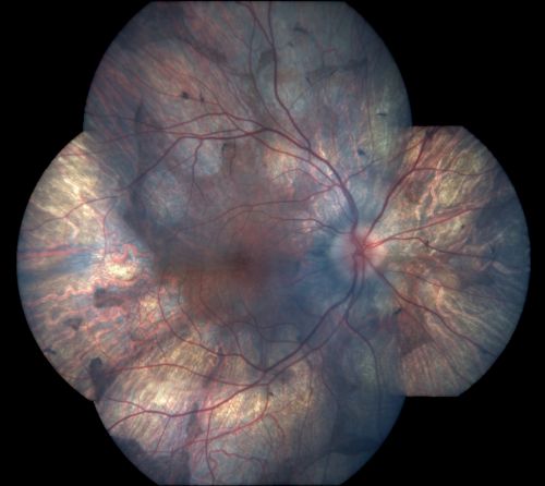 Gyrate Atrophy - 15 year old male - 20/25 vision both eyes - Positive Family History
15 year old male was diagnosed with â€œretinitis pigmentosaâ€ at age seven.  The patient reports that his night vision is poor.  He reports he does not notice a visual field change.  He reports that his maternal grandfather has lost vision and a cousin has lost vision as well.  He reports he has an uncle with some visual changes.
The most significantly affected relative is a 26-year-old legally blind cousin.
 20/25+ OD, 20/25 OS. 

