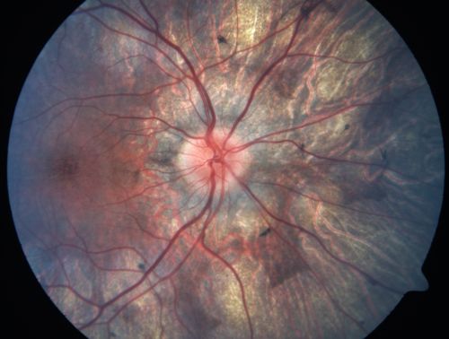 Gyrate Atrophy - 15 year old male - 20/25 vision both eyes - Positive Family History
15 year old male was diagnosed with â€œretinitis pigmentosaâ€ at age seven.  The patient reports that his night vision is poor.  He reports he does not notice a visual field change.  He reports that his maternal grandfather has lost vision and a cousin has lost vision as well.  He reports he has an uncle with some visual changes.
The most significantly affected relative is a 26-year-old legally blind cousin.
 20/25+ OD, 20/25 OS. 
