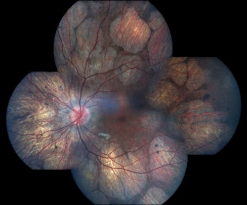 Gyrate Atrophy - 15 year old male - 20/25 vision both eyes - Positive Family History
15 year old male was diagnosed with â€œretinitis pigmentosaâ€ at age seven.  The patient reports that his night vision is poor.  He reports he does not notice a visual field change.  He reports that his maternal grandfather has lost vision and a cousin has lost vision as well.  He reports he has an uncle with some visual changes.
The most significantly affected relative is a 26-year-old legally blind cousin.
 20/25+ OD, 20/25 OS. 
