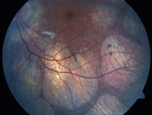 Gyrate Atrophy - 15 year old male - 20/25 vision both eyes - Positive Family History
15 year old male was diagnosed with â€œretinitis pigmentosaâ€ at age seven.  The patient reports that his night vision is poor.  He reports he does not notice a visual field change.  He reports that his maternal grandfather has lost vision and a cousin has lost vision as well.  He reports he has an uncle with some visual changes.
The most significantly affected relative is a 26-year-old legally blind cousin.
 20/25+ OD, 20/25 OS. 
