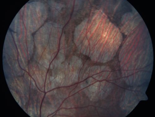 Gyrate Atrophy - 15 year old male - 20/25 vision both eyes - Positive Family History
15 year old male was diagnosed with â€œretinitis pigmentosaâ€ at age seven.  The patient reports that his night vision is poor.  He reports he does not notice a visual field change.  He reports that his maternal grandfather has lost vision and a cousin has lost vision as well.  He reports he has an uncle with some visual changes.
The most significantly affected relative is a 26-year-old legally blind cousin.
 20/25+ OD, 20/25 OS. 
