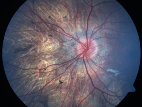 Gyrate Atrophy - 15 year old male - 20/25 vision both eyes - Positive Family History
15 year old male was diagnosed with â€œretinitis pigmentosaâ€ at age seven.  The patient reports that his night vision is poor.  He reports he does not notice a visual field change.  He reports that his maternal grandfather has lost vision and a cousin has lost vision as well.  He reports he has an uncle with some visual changes.
The most significantly affected relative is a 26-year-old legally blind cousin.
 20/25+ OD, 20/25 OS. 
