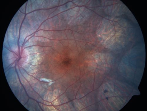 Gyrate Atrophy - 15 year old male - 20/25 vision both eyes - Positive Family History
15 year old male was diagnosed with â€œretinitis pigmentosaâ€ at age seven.  The patient reports that his night vision is poor.  He reports he does not notice a visual field change.  He reports that his maternal grandfather has lost vision and a cousin has lost vision as well.  He reports he has an uncle with some visual changes.
The most significantly affected relative is a 26-year-old legally blind cousin.
 20/25+ OD, 20/25 OS. 
