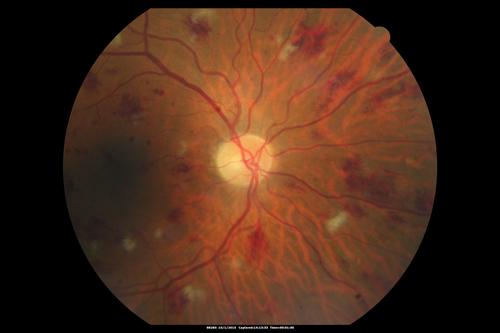 Hairy Cell Leukemia - Retinal Hemorrhage and twig Branch Vein Occlusion
79 year old man He has had hairy cell leukemia since 2002.  He is in remission.  His last blood tests were 9/2018.  He just moved down here and needs a new leukemia doctor.  His vision is fine. 
VA OD: Dcc20/25
VA OS: Dcc20/25
IOP: TP: OD:12 OS:12
