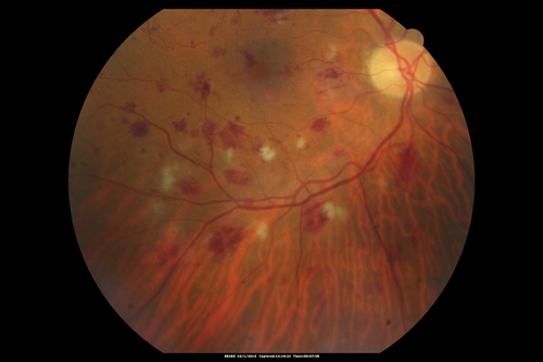 Hairy Cell Leukemia - Retinal Hemorrhage and twig Branch Vein Occlusion
79 year old man He has had hairy cell leukemia since 2002.  He is in remission.  His last blood tests were 9/2018.  He just moved down here and needs a new leukemia doctor.  His vision is fine. 
VA OD: Dcc20/25
VA OS: Dcc20/25
IOP: TP: OD:12 OS:12
